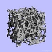 Image 3D d'un os ostéoporotique